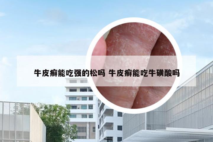 牛皮癣能吃强的松吗 牛皮癣能吃牛磺酸吗