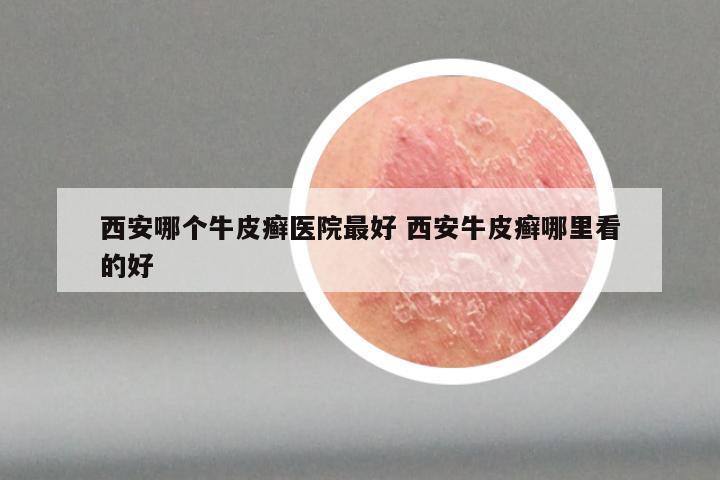 西安哪个牛皮癣医院最好 西安牛皮癣哪里看的好