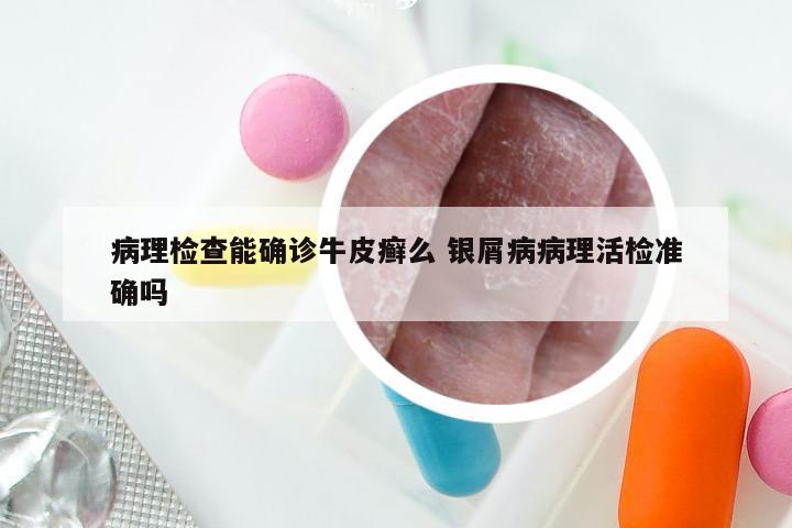 病理检查能确诊牛皮癣么 银屑病病理活检准确吗