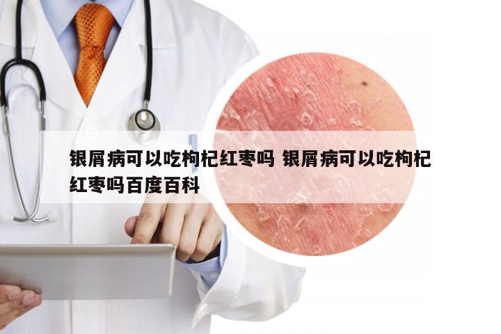 银屑病可以吃枸杞红枣吗 银屑病可以吃枸杞红枣吗百度百科