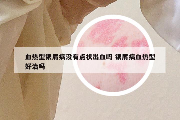 血热型银屑病没有点状出血吗 银屑病血热型好治吗