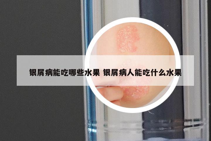 银屑病能吃哪些水果 银屑病人能吃什么水果