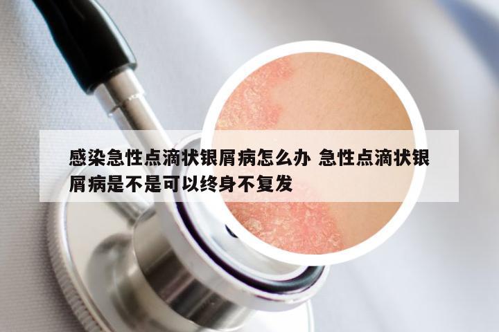 感染急性点滴状银屑病怎么办 急性点滴状银屑病是不是可以终身不复发