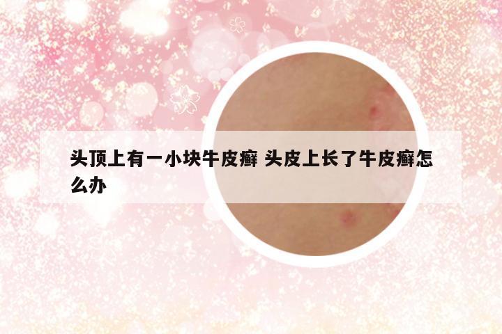 头顶上有一小块牛皮癣 头皮上长了牛皮癣怎么办