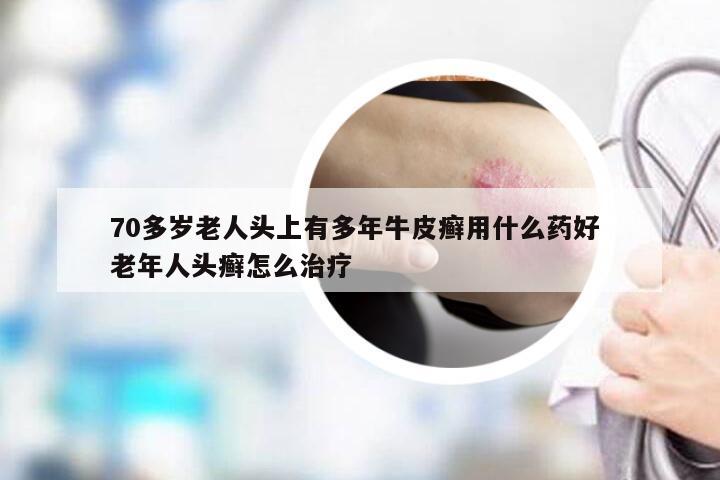 70多岁老人头上有多年牛皮癣用什么药好 老年人头癣怎么治疗