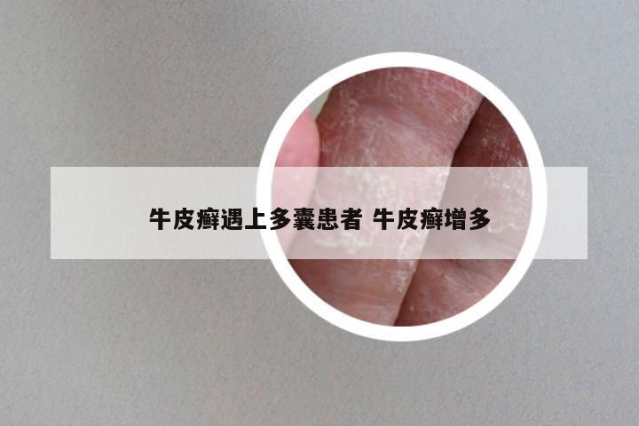牛皮癣遇上多囊患者 牛皮癣增多