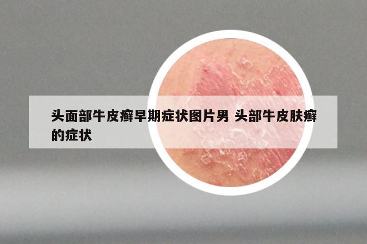 头面部牛皮癣早期症状图片男 头部牛皮肤癣的症状