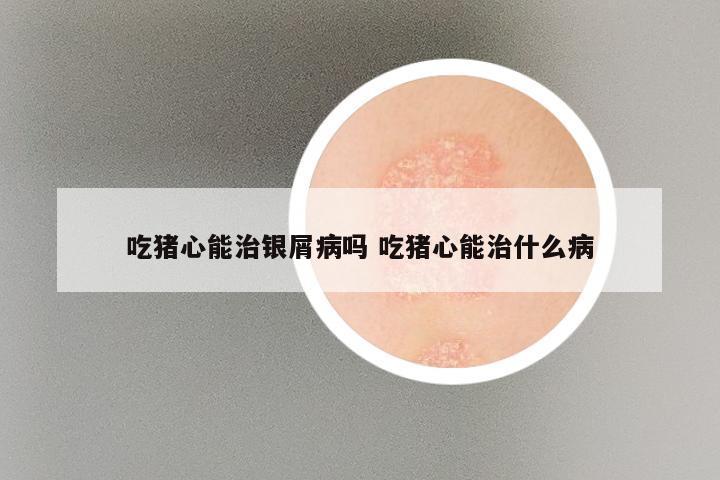 吃猪心能治银屑病吗 吃猪心能治什么病