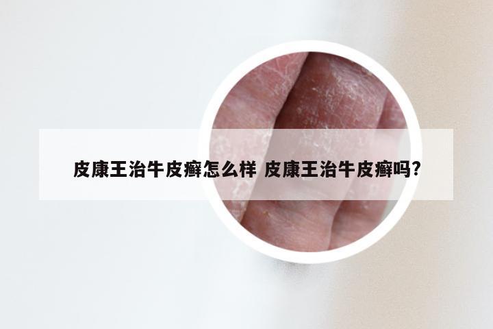 皮康王治牛皮癣怎么样 皮康王治牛皮癣吗?