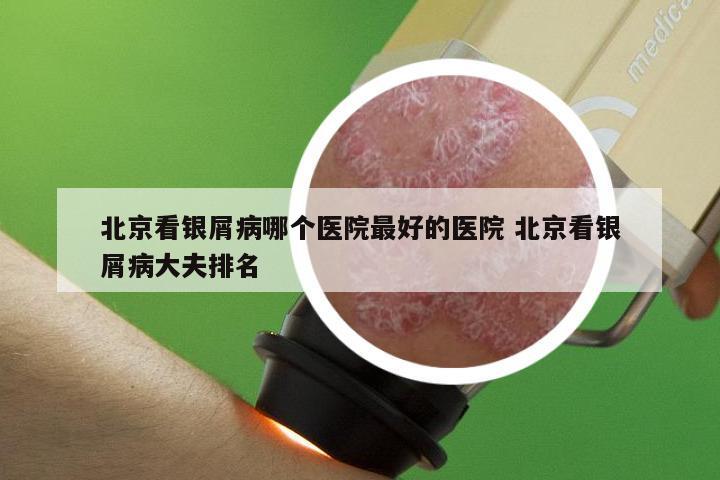 北京看银屑病哪个医院最好的医院 北京看银屑病大夫排名