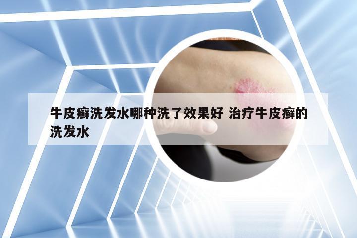 牛皮癣洗发水哪种洗了效果好 治疗牛皮癣的洗发水