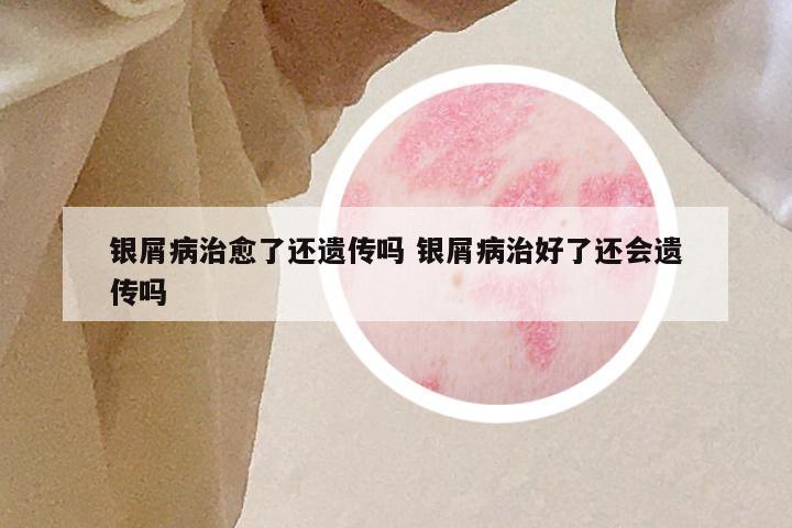 银屑病治愈了还遗传吗 银屑病治好了还会遗传吗