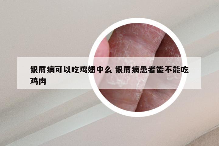 银屑病可以吃鸡翅中么 银屑病患者能不能吃鸡肉