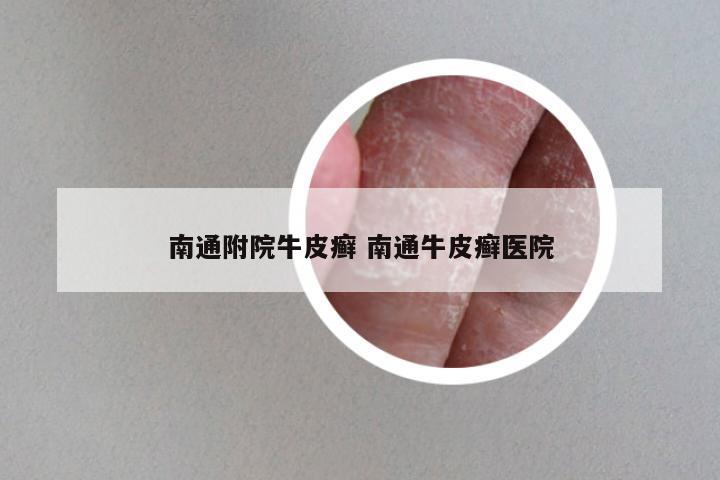 南通附院牛皮癣 南通牛皮癣医院