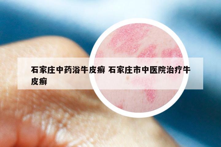 石家庄中药浴牛皮癣 石家庄市中医院治疗牛皮癣
