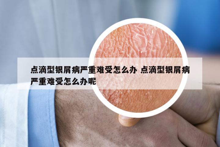 点滴型银屑病严重难受怎么办 点滴型银屑病严重难受怎么办呢