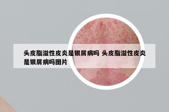 头皮脂溢性皮炎是银屑病吗 头皮脂溢性皮炎是银屑病吗图片