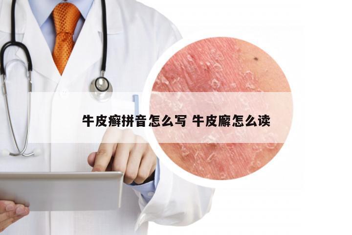 牛皮癣拼音怎么写 牛皮廨怎么读