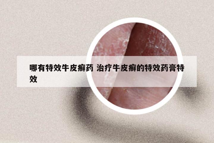 哪有特效牛皮癣药 治疗牛皮癣的特效药膏特效