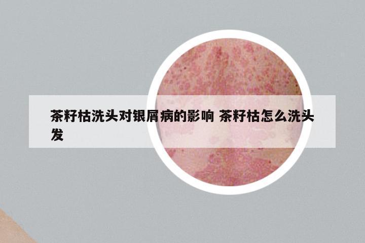 茶籽枯洗头对银屑病的影响 茶籽枯怎么洗头发