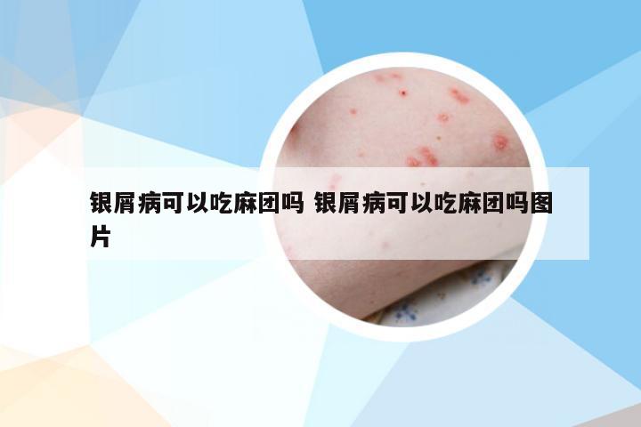 银屑病可以吃麻团吗 银屑病可以吃麻团吗图片
