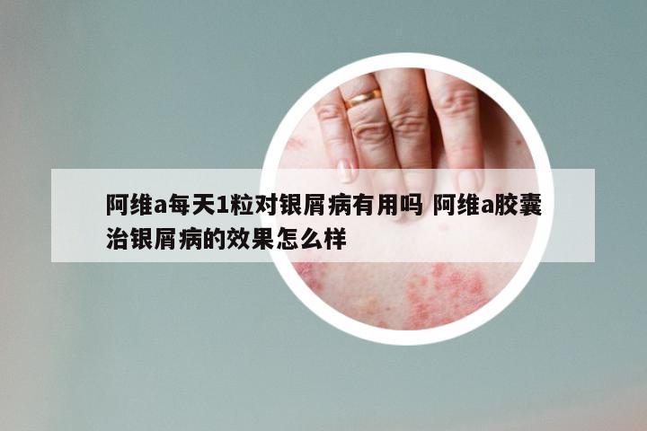 阿维a每天1粒对银屑病有用吗 阿维a胶囊治银屑病的效果怎么样