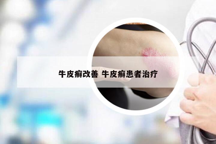 牛皮癣改善 牛皮癣患者治疗