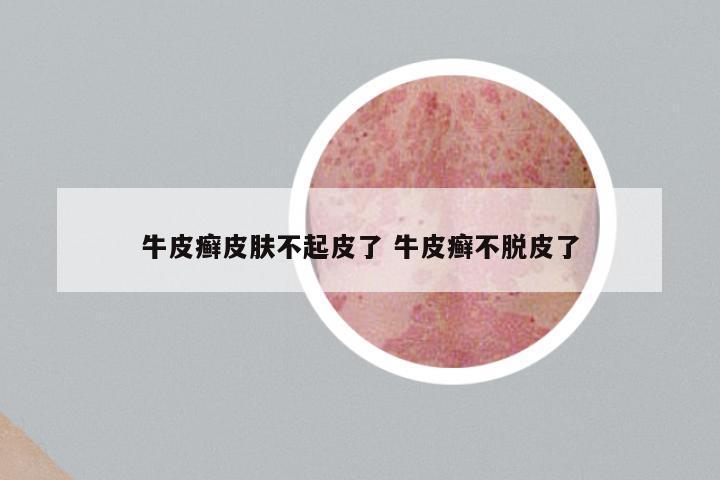 牛皮癣皮肤不起皮了 牛皮癣不脱皮了