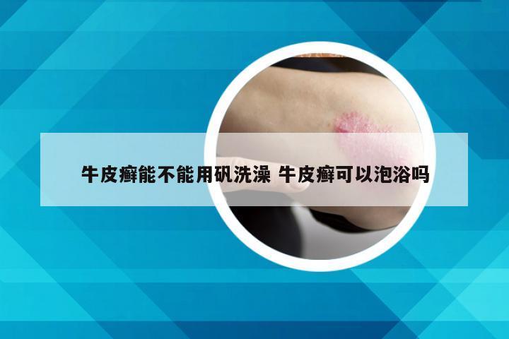 牛皮癣能不能用矾洗澡 牛皮癣可以泡浴吗