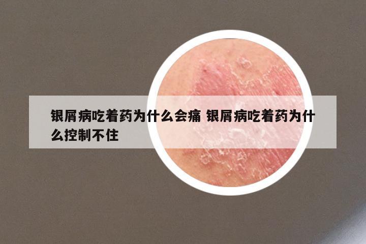 银屑病吃着药为什么会痛 银屑病吃着药为什么控制不住