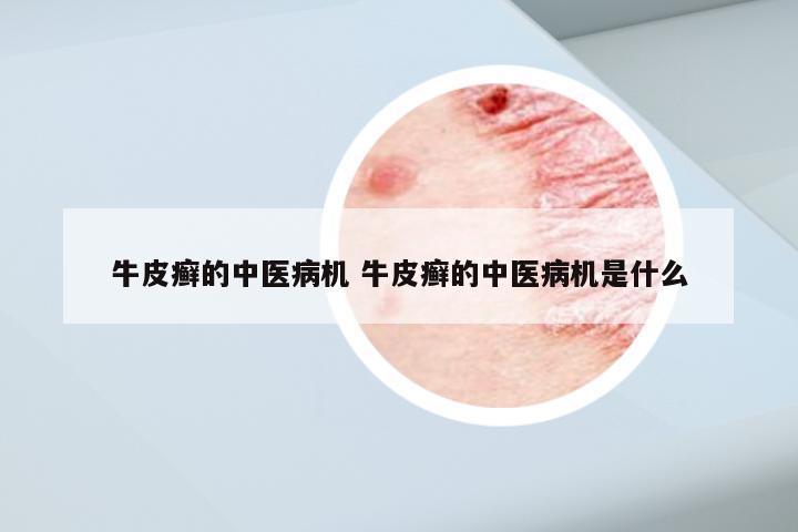 牛皮癣的中医病机 牛皮癣的中医病机是什么