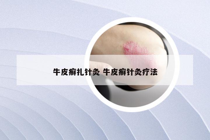 牛皮癣扎针灸 牛皮癣针灸疗法