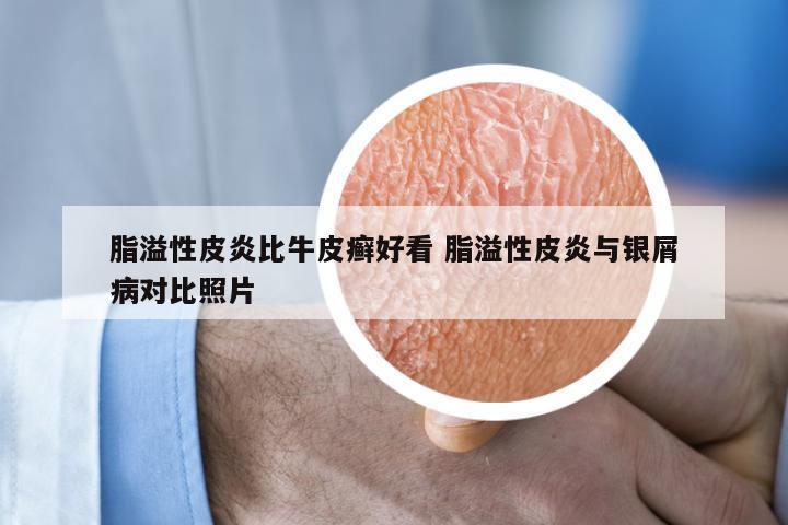 脂溢性皮炎比牛皮癣好看 脂溢性皮炎与银屑病对比照片