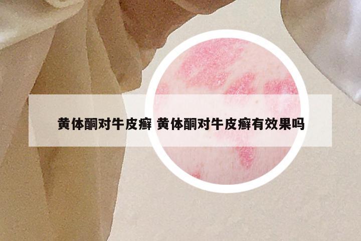黄体酮对牛皮癣 黄体酮对牛皮癣有效果吗