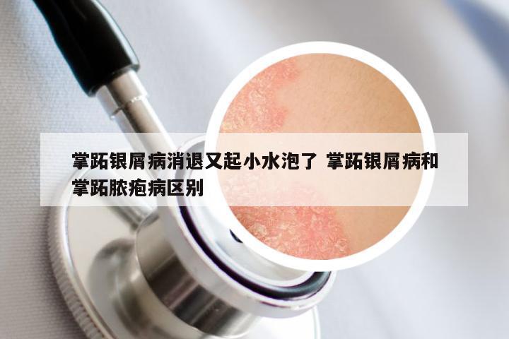 掌跖银屑病消退又起小水泡了 掌跖银屑病和掌跖脓疱病区别