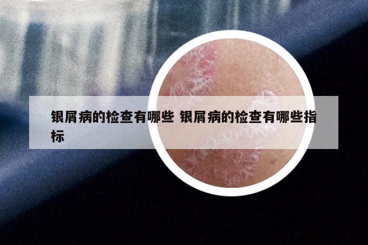 银屑病的检查有哪些 银屑病的检查有哪些指标