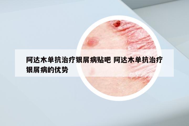 阿达木单抗治疗银屑病贴吧 阿达木单抗治疗银屑病的优势