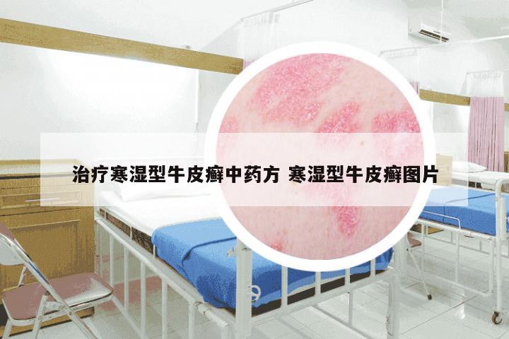 治疗寒湿型牛皮癣中药方 寒湿型牛皮癣图片
