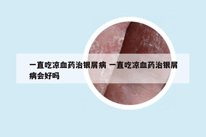 一直吃凉血药治银屑病 一直吃凉血药治银屑病会好吗