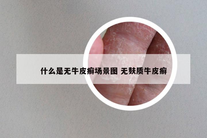 什么是无牛皮癣场景图 无麸质牛皮癣