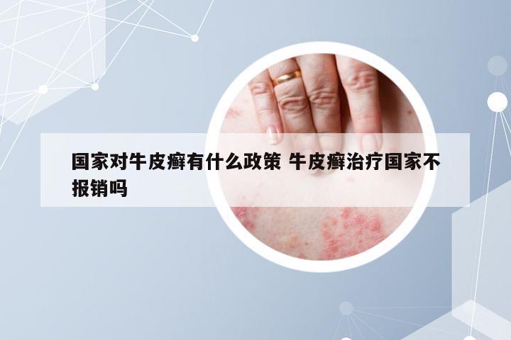国家对牛皮癣有什么政策 牛皮癣治疗国家不报销吗