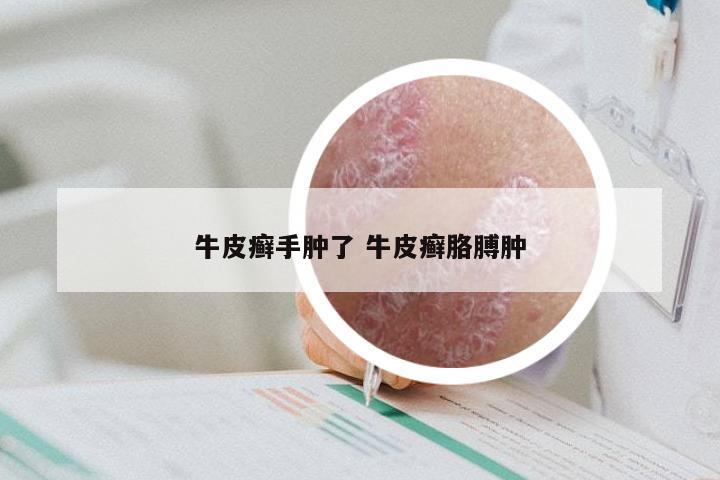 牛皮癣手肿了 牛皮癣胳膊肿
