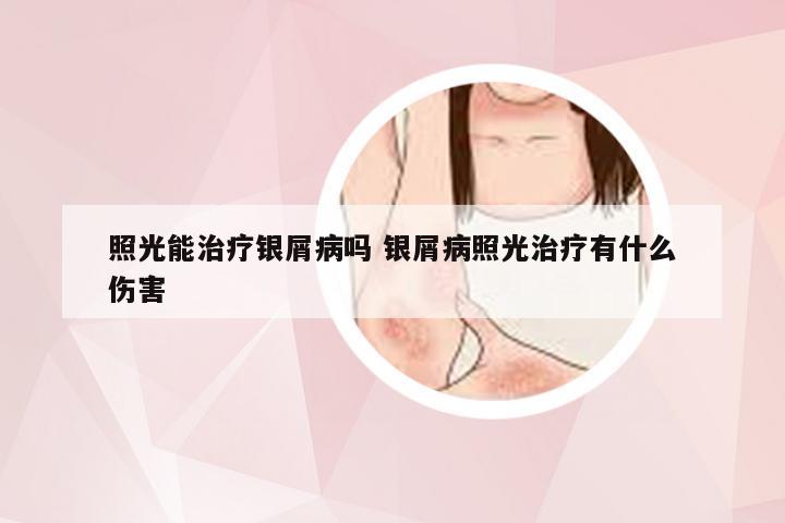 照光能治疗银屑病吗 银屑病照光治疗有什么伤害