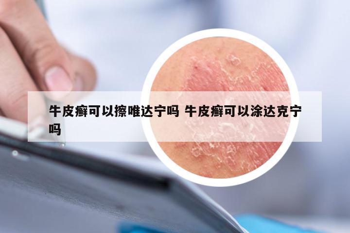 牛皮癣可以擦唯达宁吗 牛皮癣可以涂达克宁吗