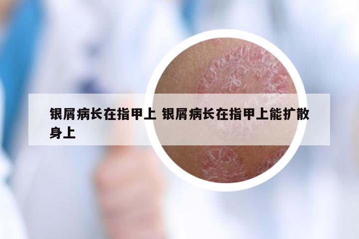 银屑病长在指甲上 银屑病长在指甲上能扩散身上