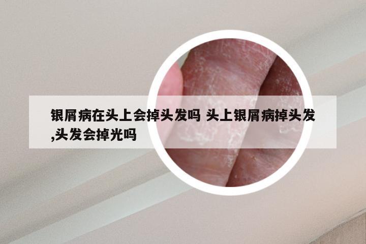 银屑病在头上会掉头发吗 头上银屑病掉头发,头发会掉光吗