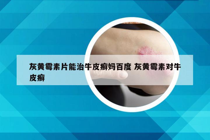 灰黄霉素片能治牛皮癣妈百度 灰黄霉素对牛皮癣