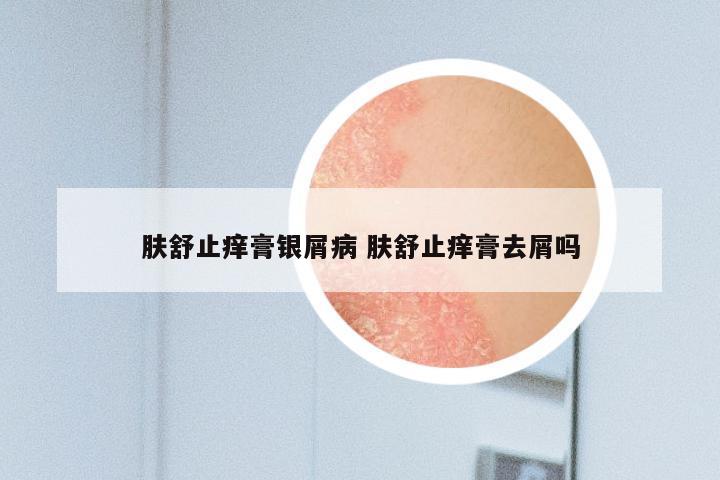 肤舒止痒膏银屑病 肤舒止痒膏去屑吗