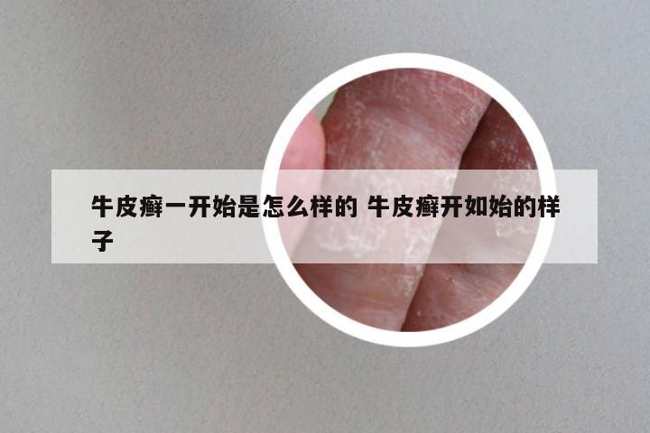牛皮癣一开始是怎么样的 牛皮癣开如始的样子