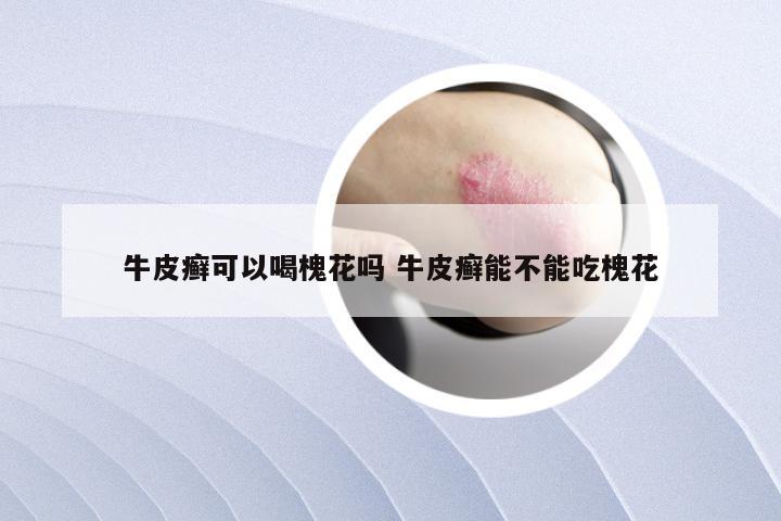 牛皮癣可以喝槐花吗 牛皮癣能不能吃槐花